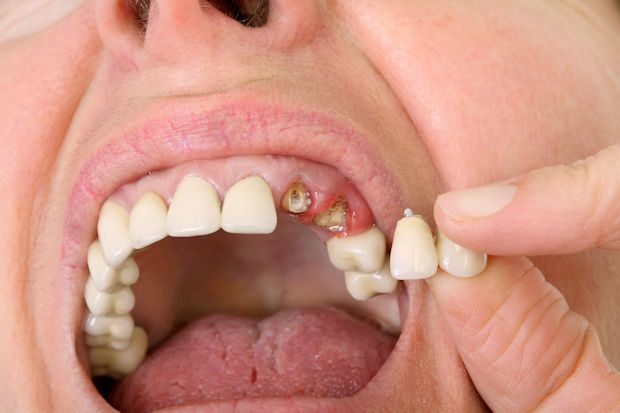 Zahnlücken können heute auf vielfältige Weise geschlossen werden, etwa durch ein fest sitzendes Implantat. Allerdings muss man sich die moderne Zahnmedizin auch leisten können.