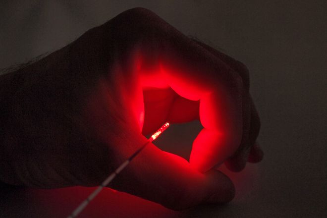 Das Laserlicht wird durch die Sonde gezielt von innen radial in die Vene abgestrahlt.