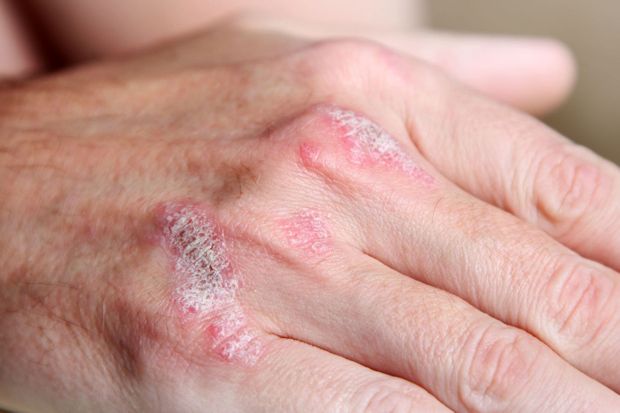 Das Spurenelement Zink kann bei Psoriasis-Patienten Rötungen und Schuppungen der Haut verringern.